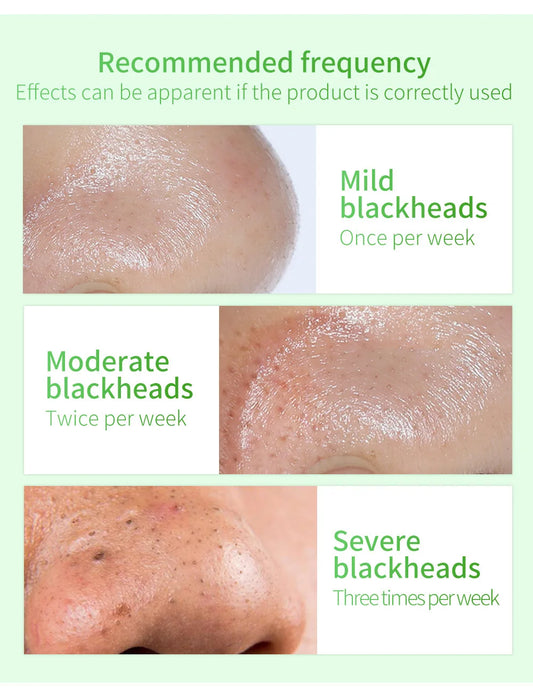 LANBENA Blackhead Remover Serum – Deep Cleansing Pore Minimizing Acne Treatment Essence - Lylamor.com