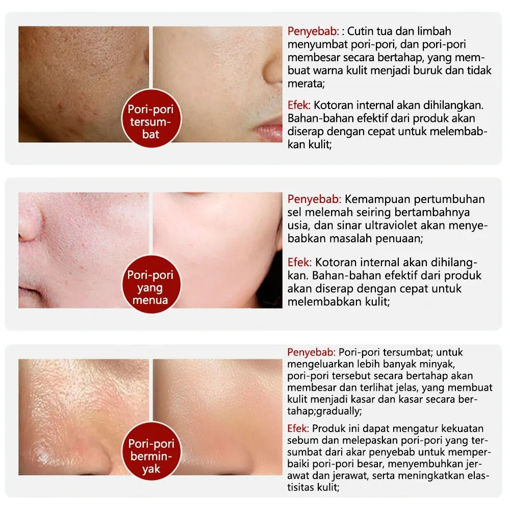 LANBENA Nose Botanical Pore Strip – Deep Cleansing Blackhead Treatment & Pore Refining Serum 30g - Lylamor.com