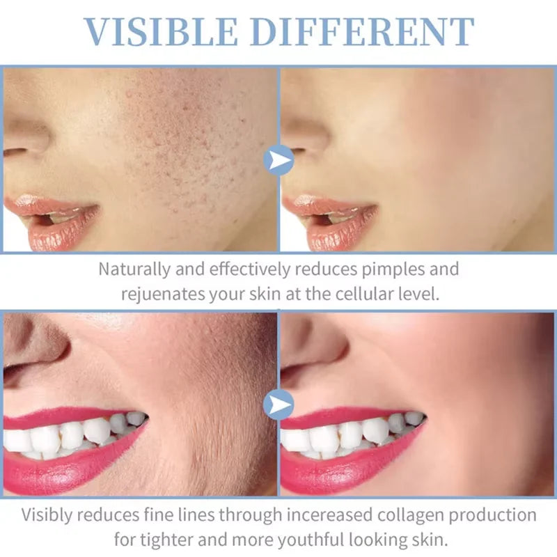 4 – in -1 High Frequency Facial Wand | Glass Electrode Skin Therapy Machine - Lylamor.com